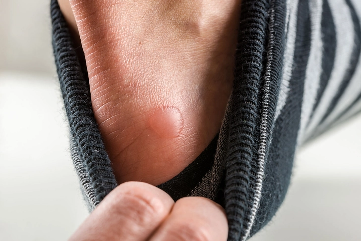 Keep Blisters at Bay