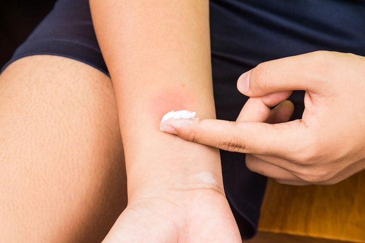 De-Sting Bug Bites