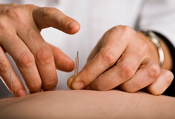 Consider Acupuncture