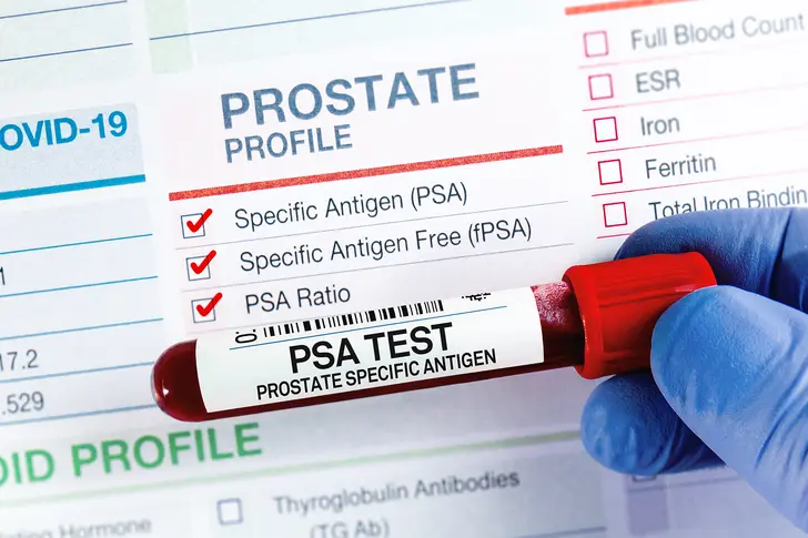 What Are PSA Levels?