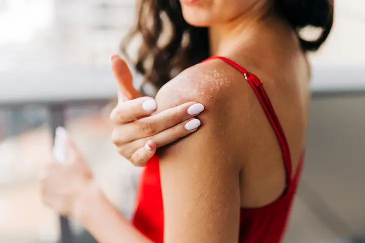 Benefit of Sunlight for Psoriasis