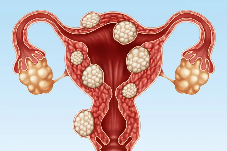 Understanding Uterine Fibroids