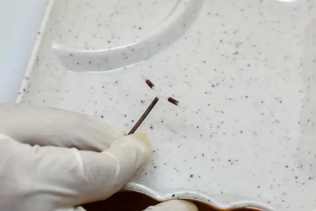 Reasons to Remove an IUD Reasons to Remove an IUD