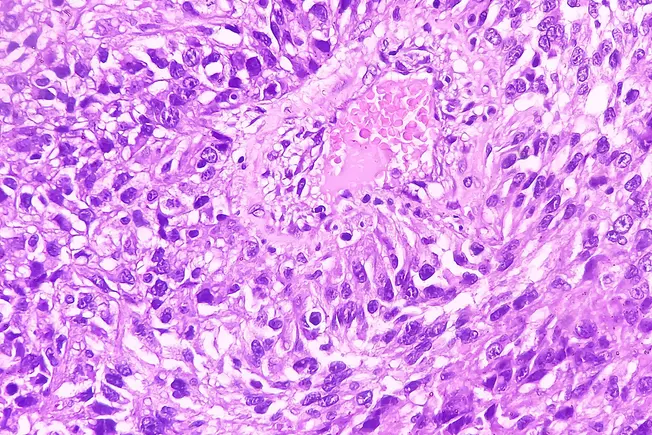 Understanding Metastatic Renal Cell Carcinoma Understanding Metastatic Renal Cell Carcinoma