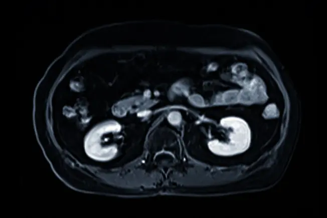 Understanding Kidney Cancer