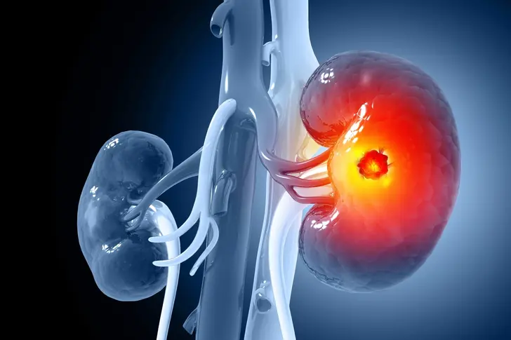 Understanding Kidney Cancer Stages