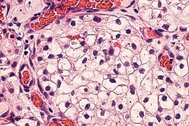 What Is Renal Cell Carcinoma? What Is Renal Cell Carcinoma?