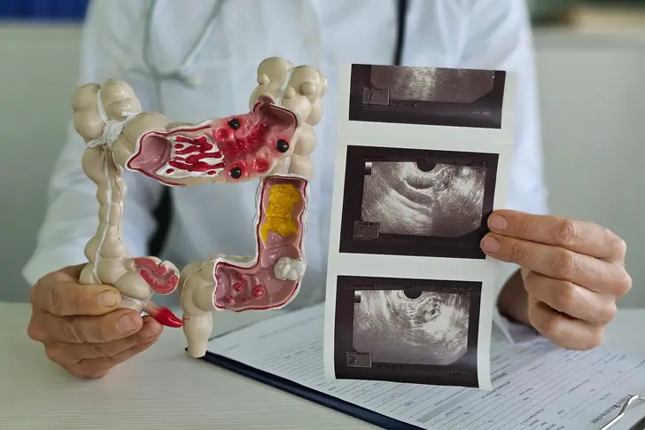 What Is Crohn's Disease?