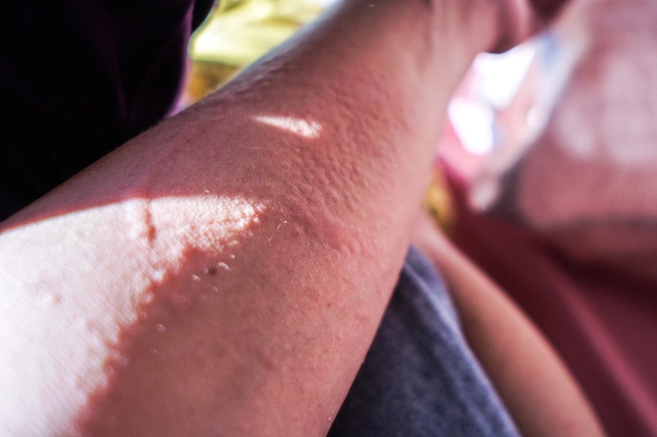 Skin Complications