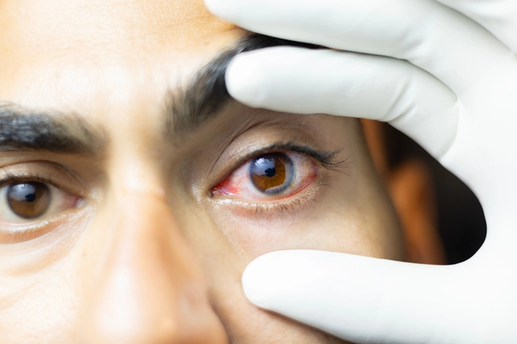 Eye Inflammation