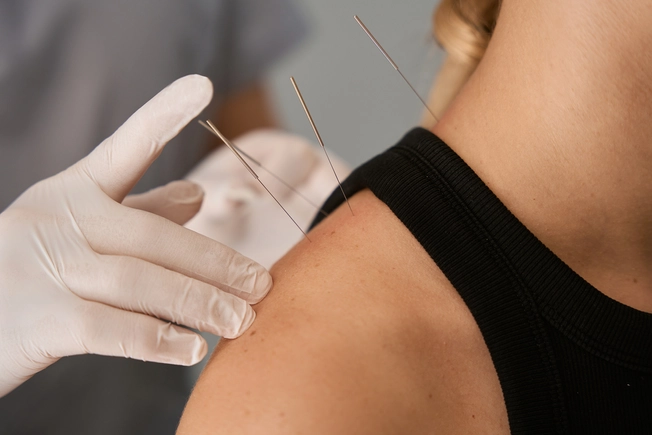 Acupuncture