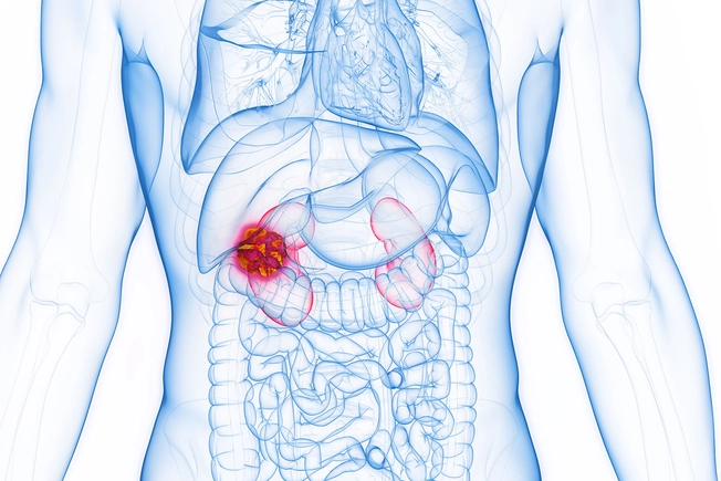 Types of Kidney Cancer