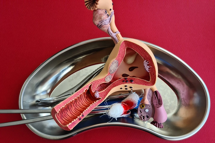 Hysterectomy: Uterus Removal