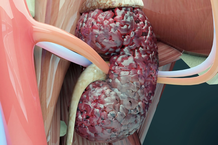 How Does Kidney Cancer Spread?