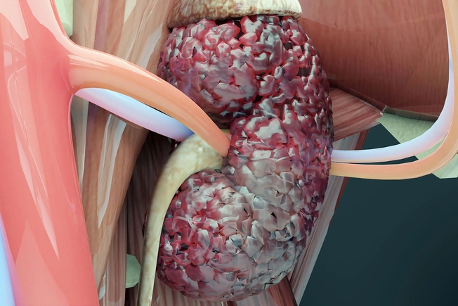 How Does Kidney Cancer Spread? How Does Kidney Cancer Spread?