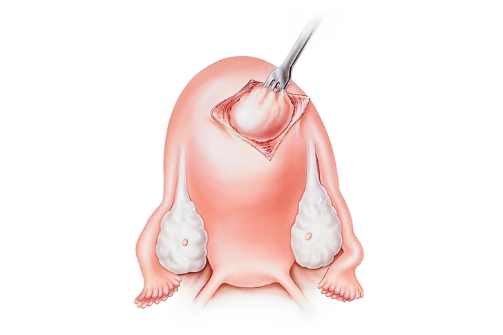 Myomectomy: Fibroid Removal