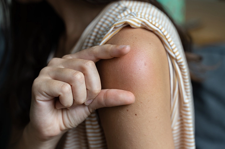 Injection Site Reactions Injection Site Reactions