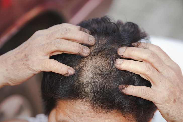 Hair Thinning Hair Thinning