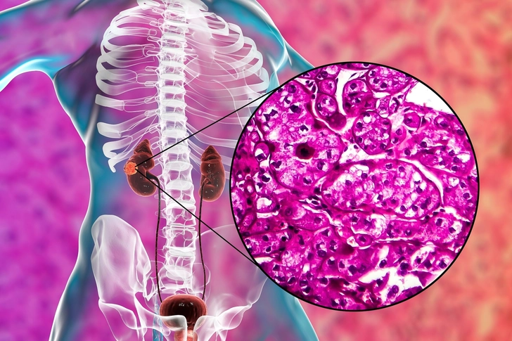 Stage I Kidney Cancer