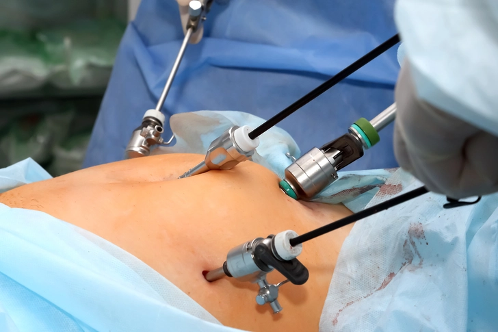 Laparoscopic Myomectomy: Minimally Invasive