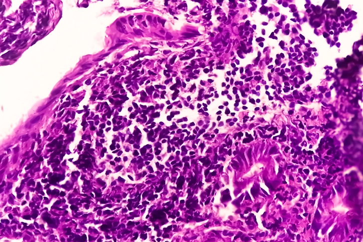 Crohn's Type: Ileitis Crohn's Type: Ileitis