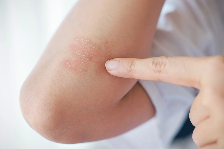 Psoriasis Symptoms