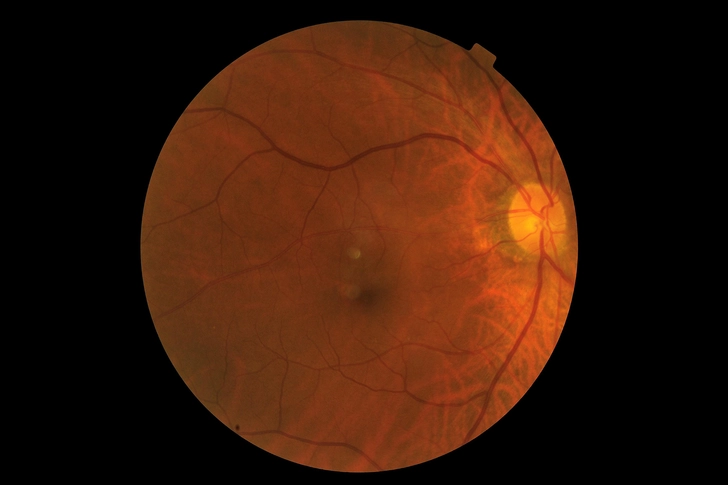 Types of AMD