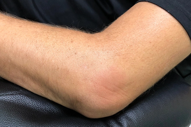 Enthesitis