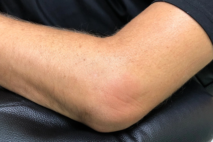 Enthesitis