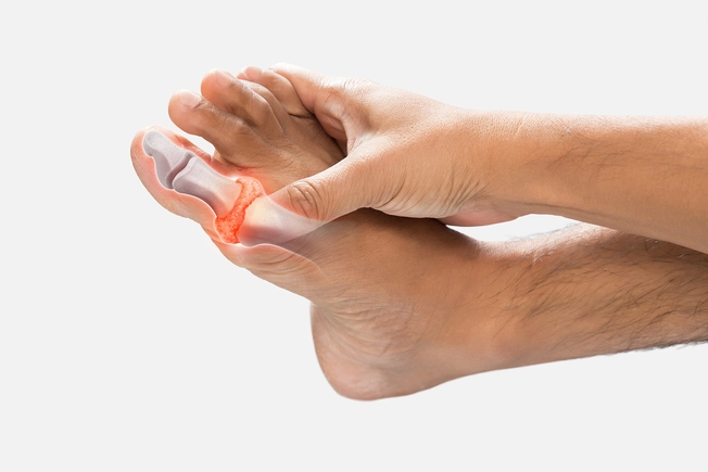 Gout