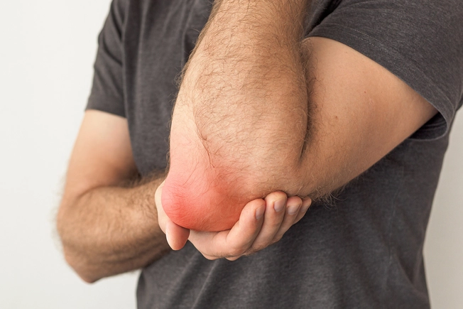 Bursitis