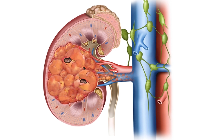 Stage II Kidney Cancer
