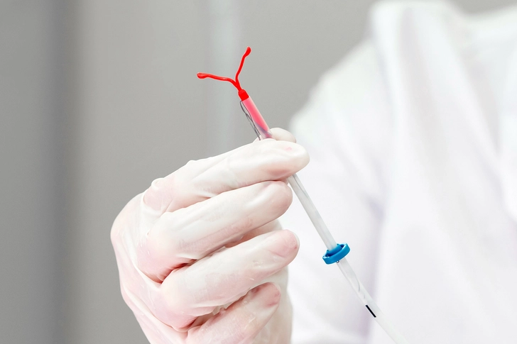 Removing an IUD