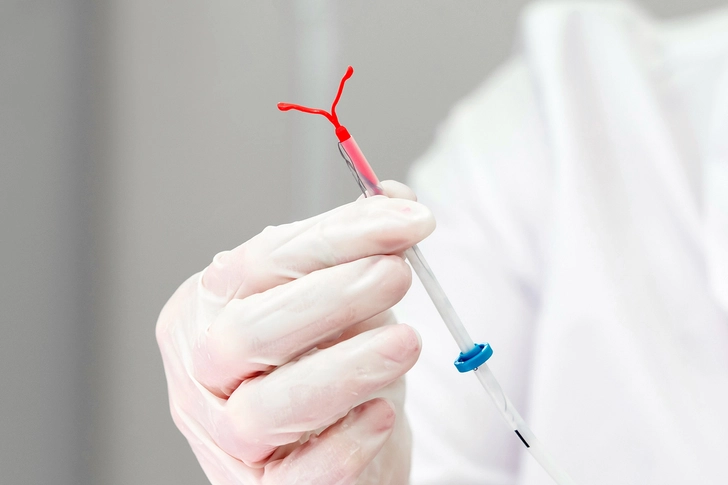 Removing an IUD Removing an IUD