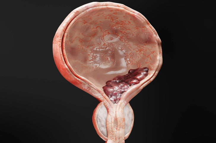 Stage I: Cancer in Connective Tissue Stage I: Cancer in Connective Tissue