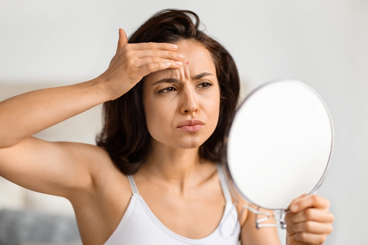 Acne and Headaches