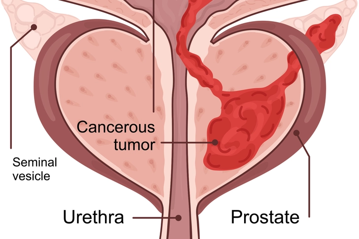 Stage III: Spread to Surrounding Tissues