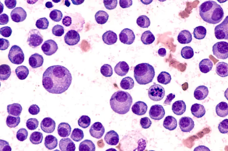 Understanding Stage III Multiple Myeloma