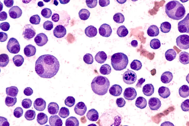 Understanding Stage III Multiple Myeloma Understanding Stage III Multiple Myeloma