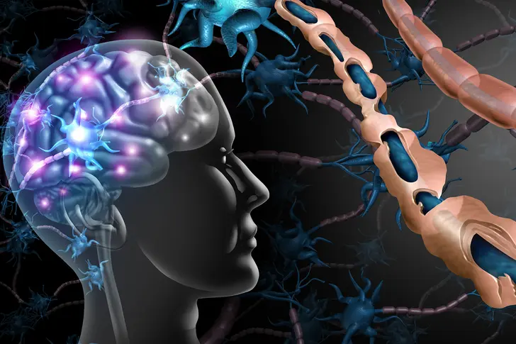 Understanding Multiple Sclerosis (MS)
