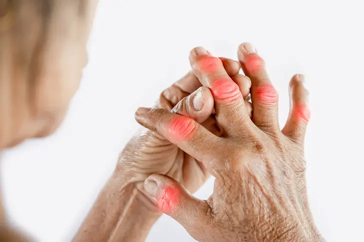 Psoriatic Arthritis on Your Hands Psoriatic Arthritis on Your Hands