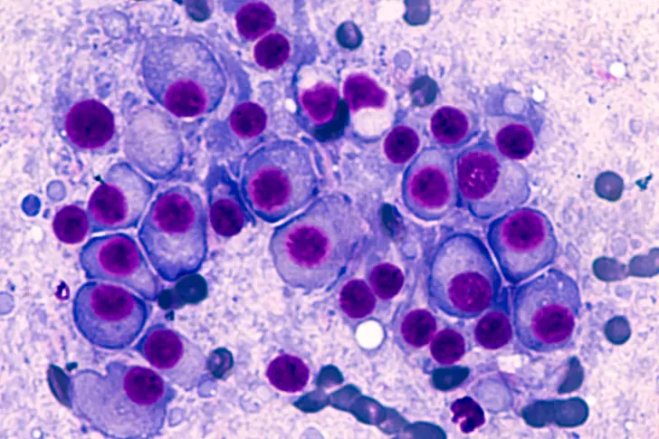 Understanding Multiple Myeloma Remission Understanding Multiple Myeloma Remission
