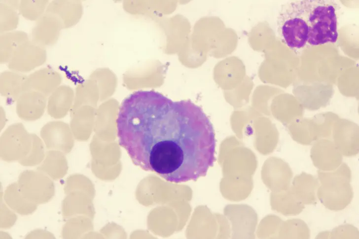 What Is Smoldering Multiple Myeloma? What Is Smoldering Multiple Myeloma?