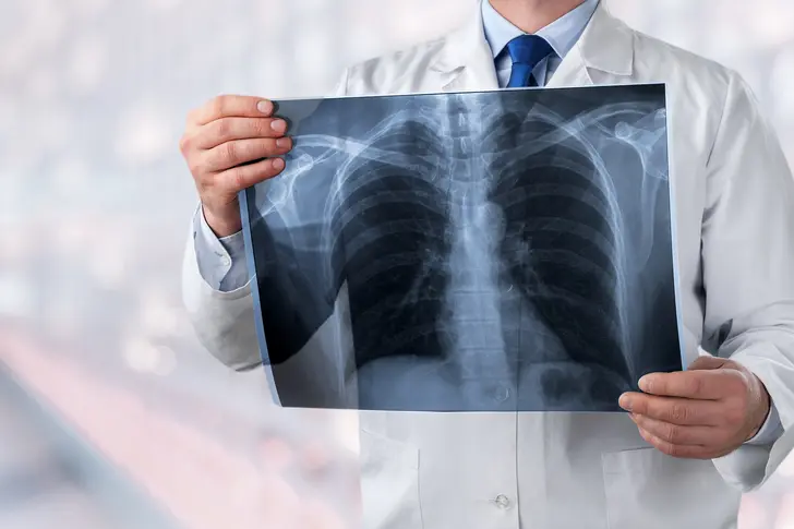 What Is a Lobectomy?