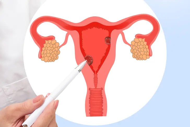 What Are Uterine Polyps?