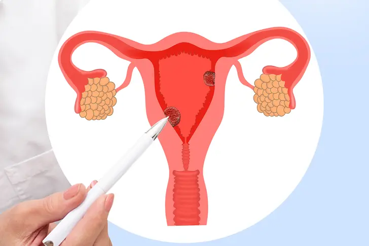 What Are Uterine Polyps? What Are Uterine Polyps?