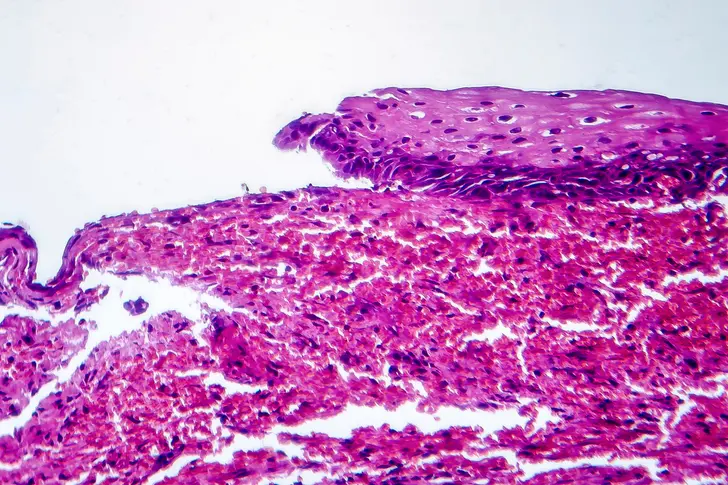 What Is Cervical Ectropion? What Is Cervical Ectropion?