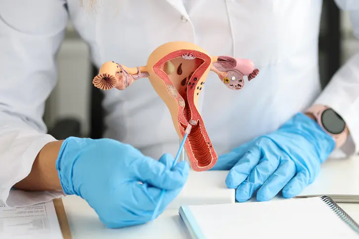 Endometrial Cancer: Treatment Overview