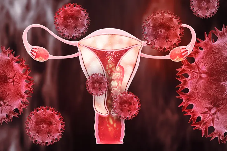 What Is Endometrial Cancer?