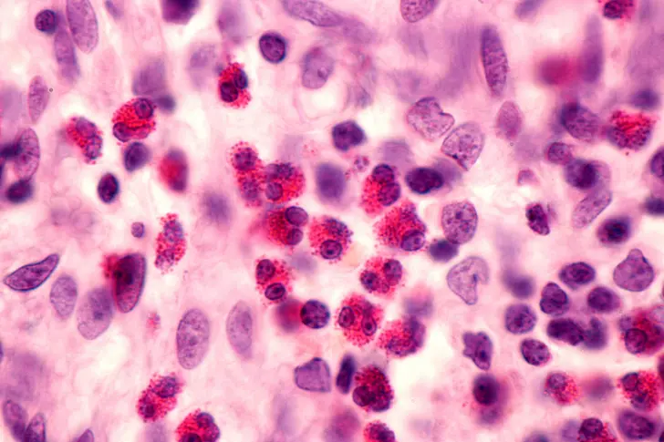 Understanding Eosinophilic Asthma